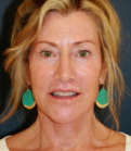 Feel Beautiful - Facelift 105 - After Photo